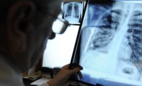 Заболеваемость и смертность от туберкулеза снизилось, – Совет по здравоохранению СНГ 