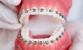 Ортодонтическое лечение займет около трех лет, – врач-ортодонт