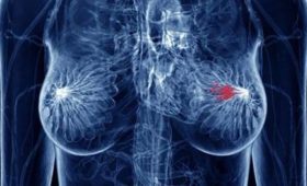 Маммолог назвала причины развития рака молочной железы у женщин