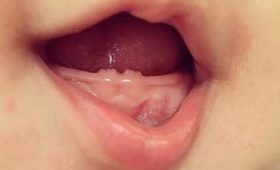 Лечение зубов детям под седацией запретили? Ответ Минздрава