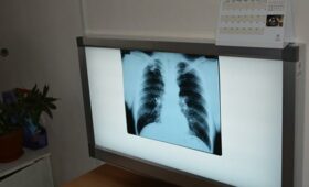 За год от туберкулеза скончались 180 кыргызстанцев