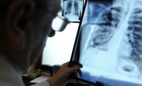 В Бишкеке за 2 месяца туберкулез выявили у 107 человек