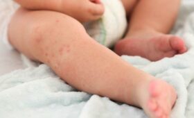 Из 8209 случаев кори 37,5% составили дети, чьи родители отказались от вакцинации. Кабмин хочет усилить ответственность родителей