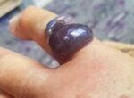 В Жалал-Абаде у трех жительниц выявлена сибирская язва