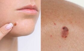 Как распознать распространенный, но редко приводящий к летальному исходу рак кожи — базальноклеточную карциному?
