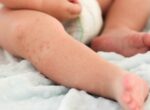 В «инфекционке» находятся 133 пациента с корью, в реанимации — 3