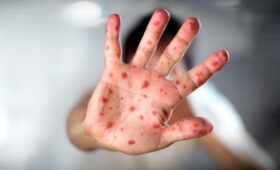 В Кыргызстане отмечается снижение заболеваемости корью, — Минздрав