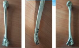 Новый хирургический метод лечения переломов представлен в КГМА