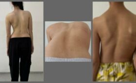 Специалисты из Узбекистана поделились опытом хирургического лечения идиопатического сколиоза у подростков