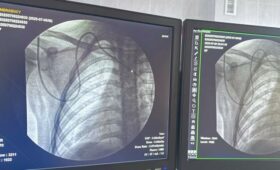 Детские онкологи Кыргызстана впервые самостоятельно установили порт-систему ребенку