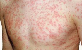 Врач: Количество пациентов с корью, обращающихся в инфекционку, не уменьшается