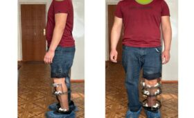 Травматологи Центр травматологи представили эффективную методику лечения открытых переломов (осторожно, фото)