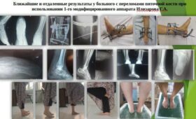 При переломах пяточной кости применение аппарата внешней фиксaции приводит к хорошим результатам. Доклад
