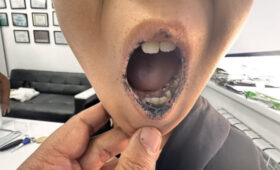 В Бишкеке у ребенка выявили редкий синдром: темные пятна на губах стали первым симптомом