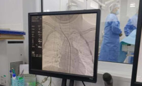 В Бишкеке детям с сосудистыми патологиями головного мозга провели эндоваскулярные операции