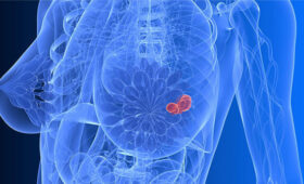 В Кыргызстане ежегодно выявляется до 900 новых случаев рака груди, — Центр онкологии