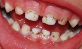 В Кыргызстане более 90% детей страдают кариесом, — Минздрав