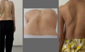 У девочек сколиоз возникает в 3 раза чаще, чем у мальчиков, — вертебролог