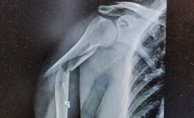 В опорно-двигательной системе детей есть свои особенности, благодаря которым перелом можно распознать не сразу, — травматолог