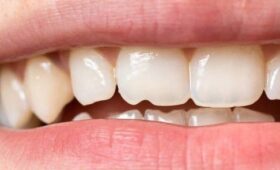 «90% детей приходят уже с кариесом». Детский стоматолог о роли молочных зубов, ошибках родителей и профилактике