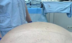 Российские врачи удалили у мужчины 60-киллограмовую опухоль