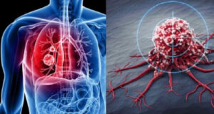 Онкологи назвали основные причины развития рака в Кыргызстане